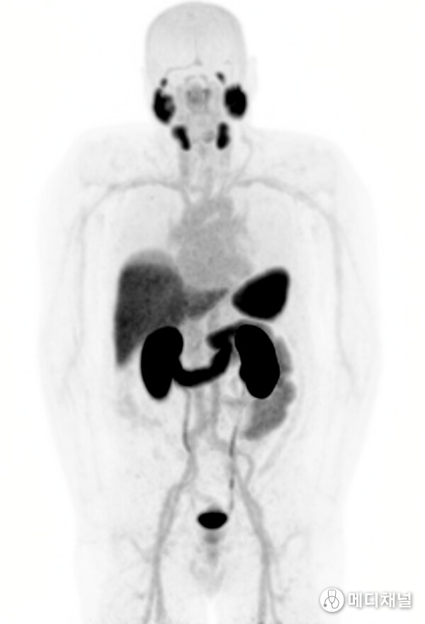 Lesion uptake of 64Cu-SAR-bisPSMA positron emission tomography (PET) at baseline (left image) and following two cycles of 67Cu-SAR-bisPSMA (8 GBq each; right image). PET image on the right was acquired 1 month after the 2nd cycle. Coloured arrows indicate representative metastatic bone lesions within each region: red – skull; blue – ribs and sternum; orange – spine; green – pelvis. Images shown as maximum intensity projections.
